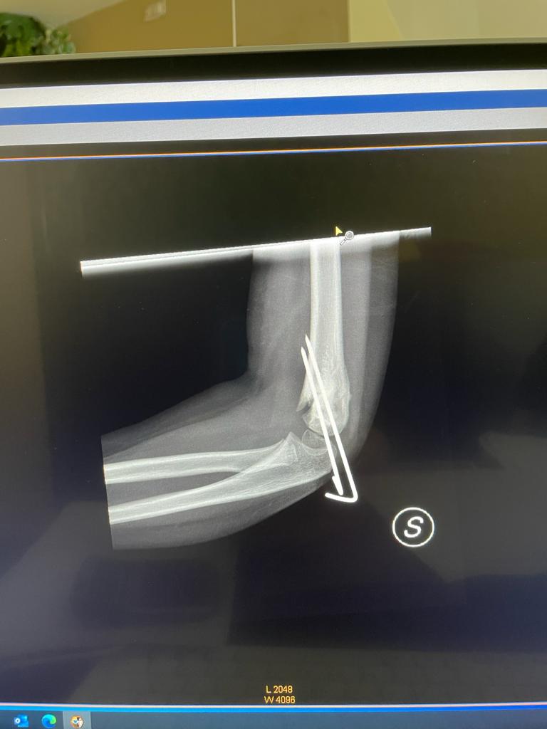 Esiti di frattura sovracondiloidea omerale composta mediante posizionamento di due fili metallici endomidollari di osteosintesi