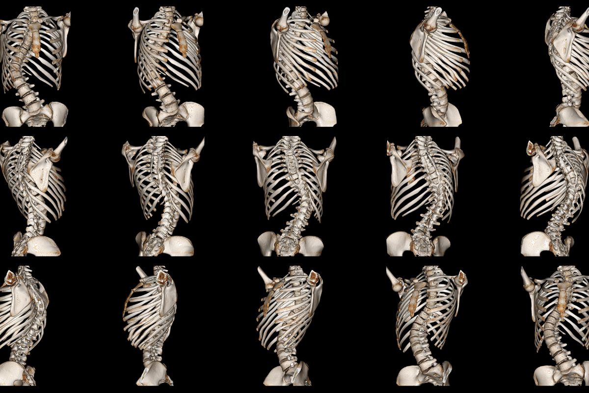 Scoliosi: come riconoscerla e come curarla con la fisioterapia