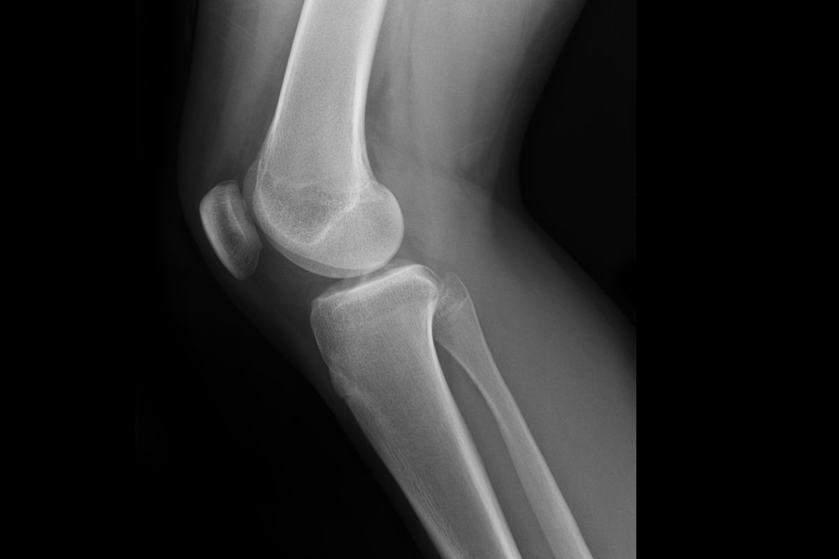 Protesi di ginocchio: l’importanza della riabilitazione post-intervento