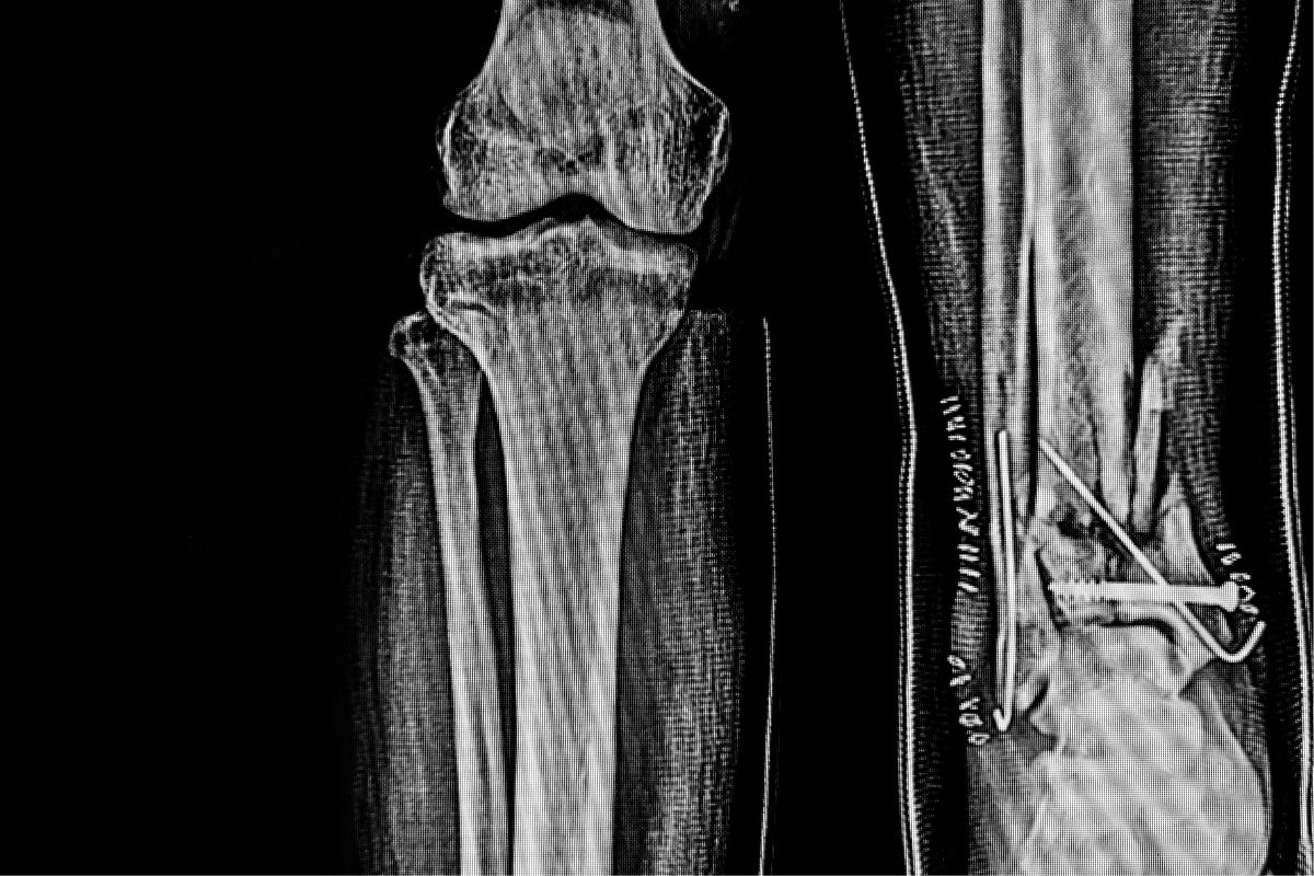 Riabilitazione dopo frattura di tibia e perone: i benefici della fisioterapia