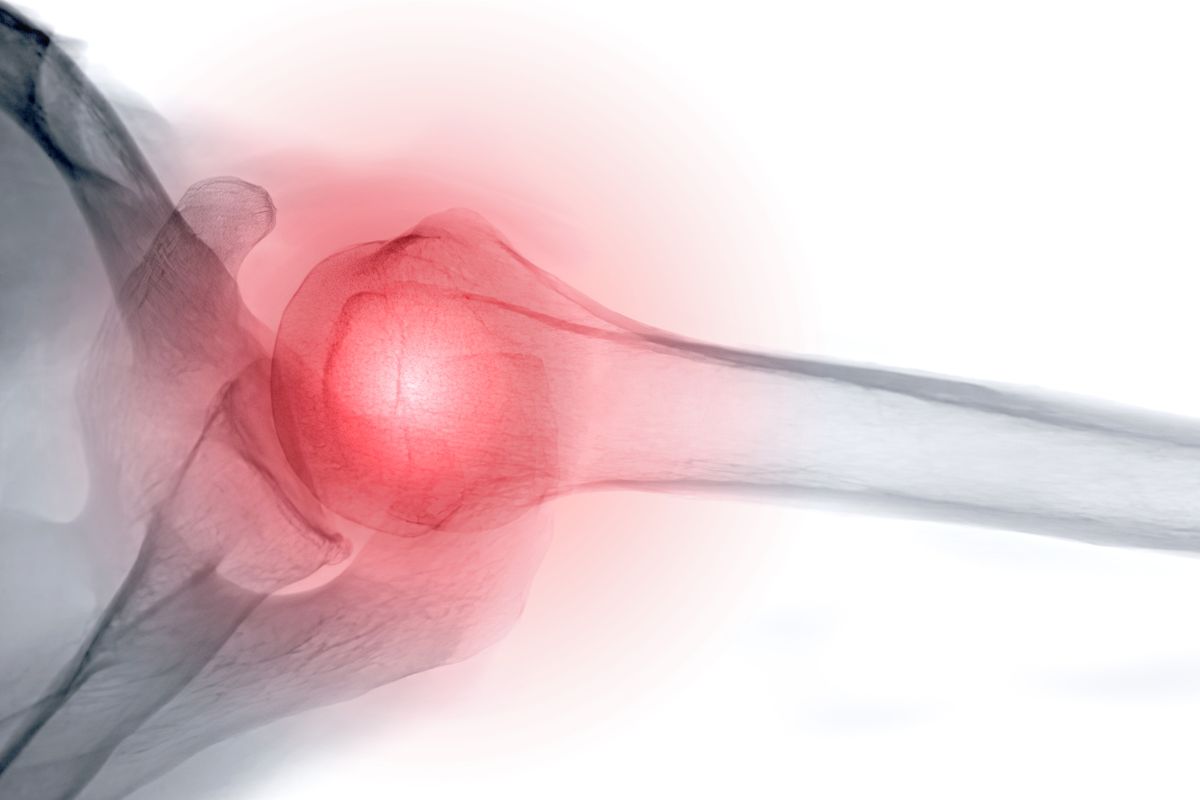 L’idrokinesiterapia negli esiti di frattura scapola